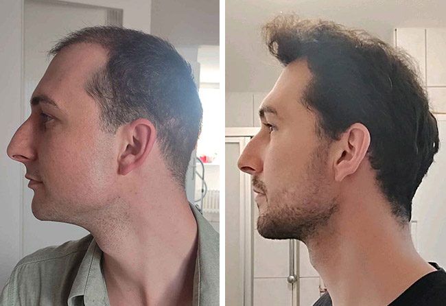 Vergleich der Ergebnisse einer Haartransplantation bei Elithair nach 3 Monaten und nach 12 Monaten