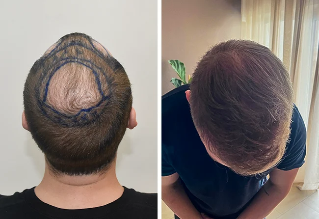 Vorher Nachher Vergleich vom Tonsur bei der Haartransplantation mit 5200 Grafts bei Patient John B.