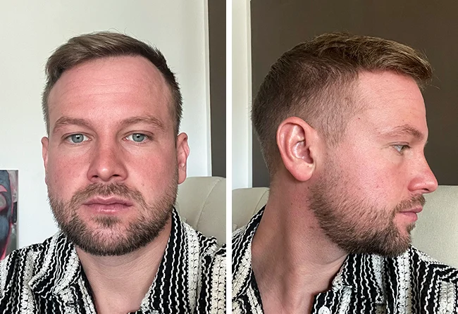 Nachher DHI Haartransplantation mit 5200 Grafts bei Patient John B.