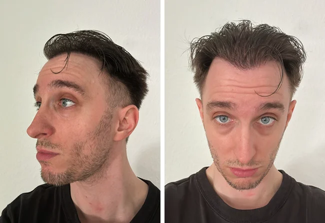 Nachher DHI Haartransplantation mit 5300 Grafts bei Patient Daniel S.