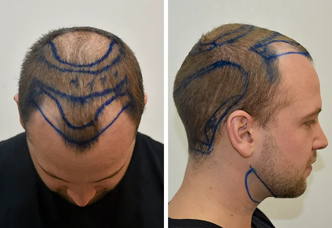 Vorher DHI Haartransplantation mit 5200 Grafts bei Patient John B.