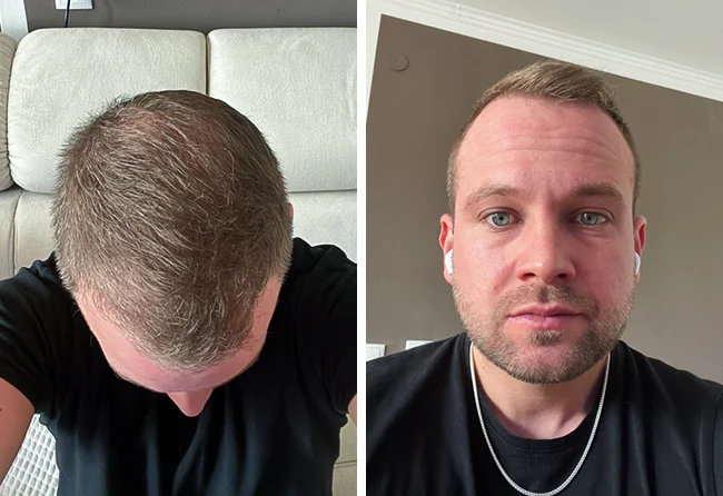 Vorher nachher DHI Haartransplantation mit 5200 Grafts bei Patient John B. nach 3 Monaten