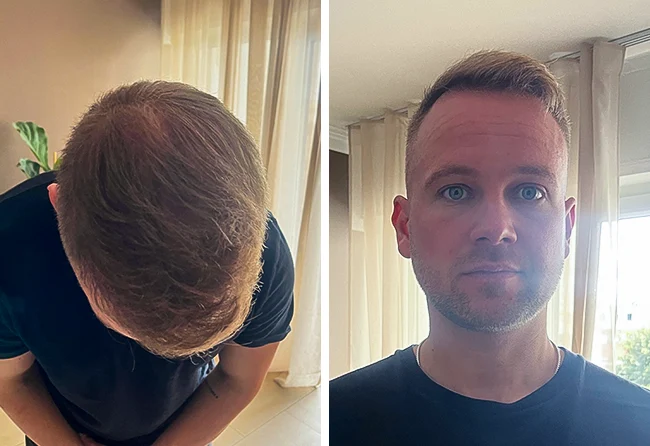 Vorher nachher DHI Haartransplantation mit 5200 Grafts bei Patient John B. nach 5 Monaten