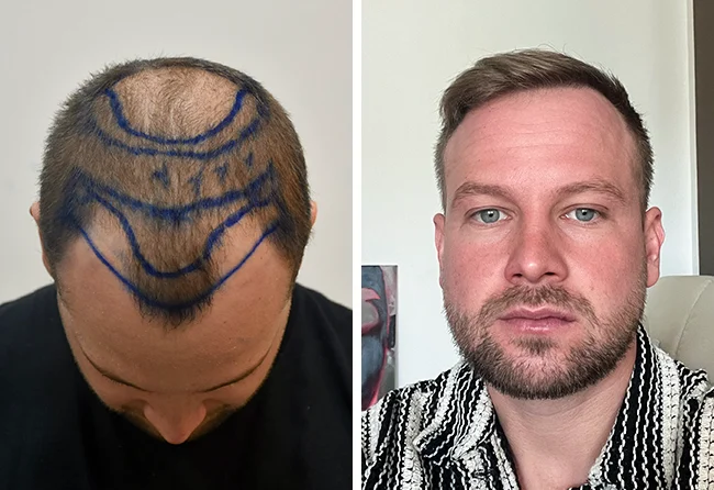 Vorher nachher DHI Haartransplantation mit 5200 Grafts bei Patient John B.