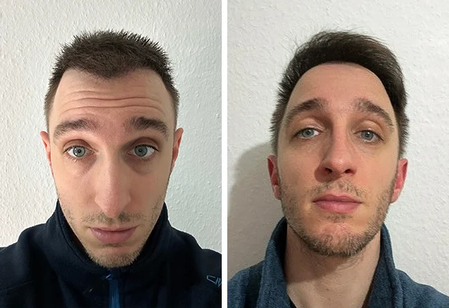 Vorher nachher DHI Haartransplantation mit 5300 Grafts bei Patient Daniel S. nach 8 und 10 Monaten