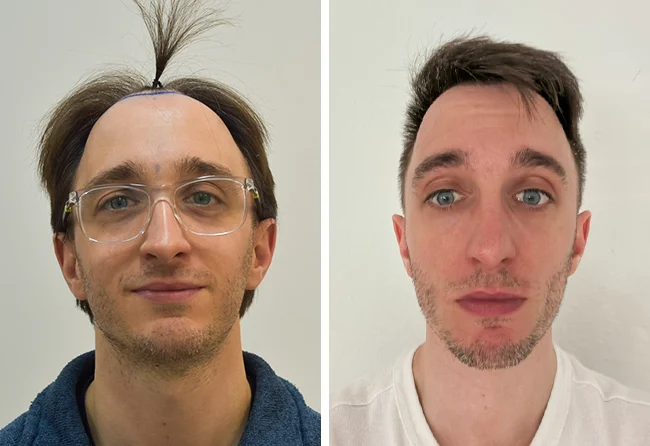 Vorher nachher DHI Haartransplantation mit 5300 Grafts bei Patient Daniel S.