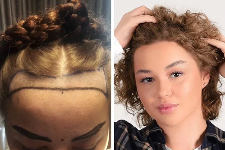 Vorher-Nachher-Ergebnis von Elithair-Patientin Lilianna S. nach einer Haartransplantation.