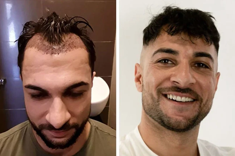 Vorher-Nachher-Ergebnis von Elithair-Patient Osmani P. nach einer Haartransplantation
