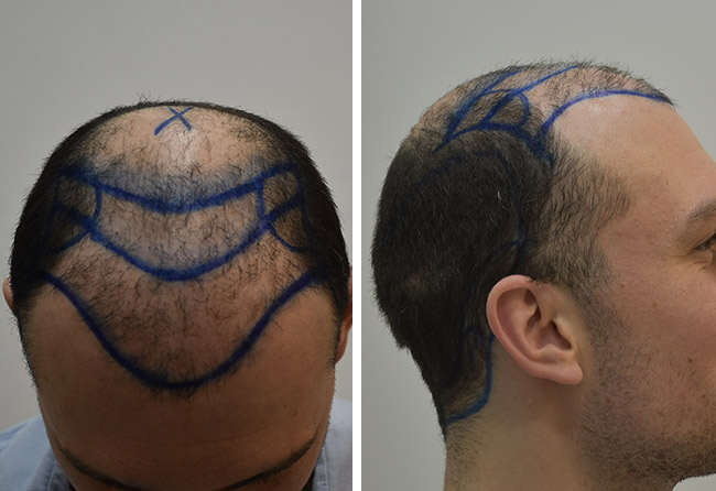 Vor der Operation – Planungsphase der Haartransplantation von Maximilian B. bei Elithair