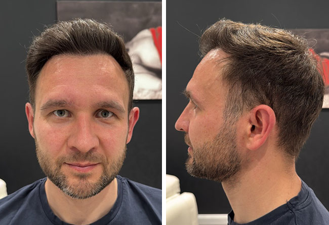 Endergebnis der Haartransplantation bei Alexander B