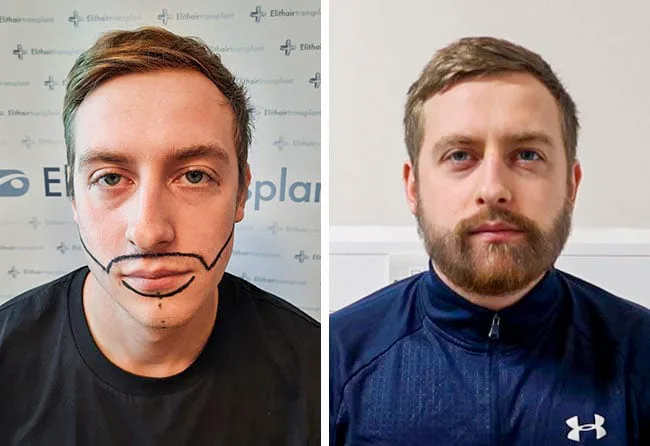 Ergebnis des Elithair-Patienten Jay J. nach Barttransplantation – dichter, gleichmäßiger Bartwuchs