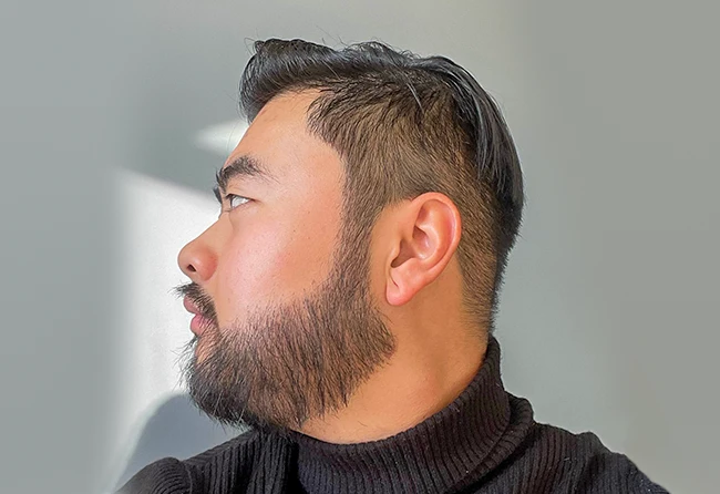 Ergebnis des Elithair-Patienten Lewi H. nach einer Barttransplantation – dichter und gleichmäßiger Bartwuchs als sichtbares Ergebnis