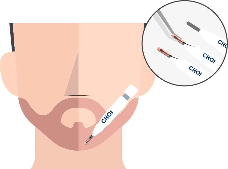Grafik zeigt das Verpflanzen der Grafts im Gesicht bei der DHI Barttransplantation