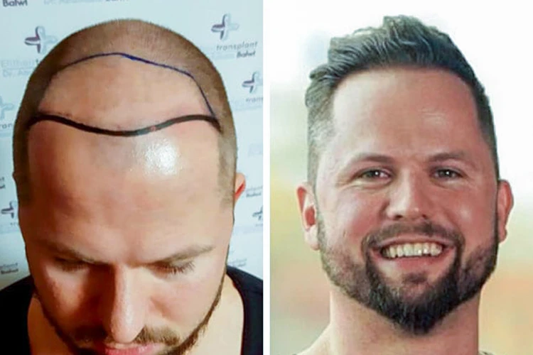 Vorher-Nachher-Bild von Elithair-Patient Nico G. nach seiner Haartransplantation
