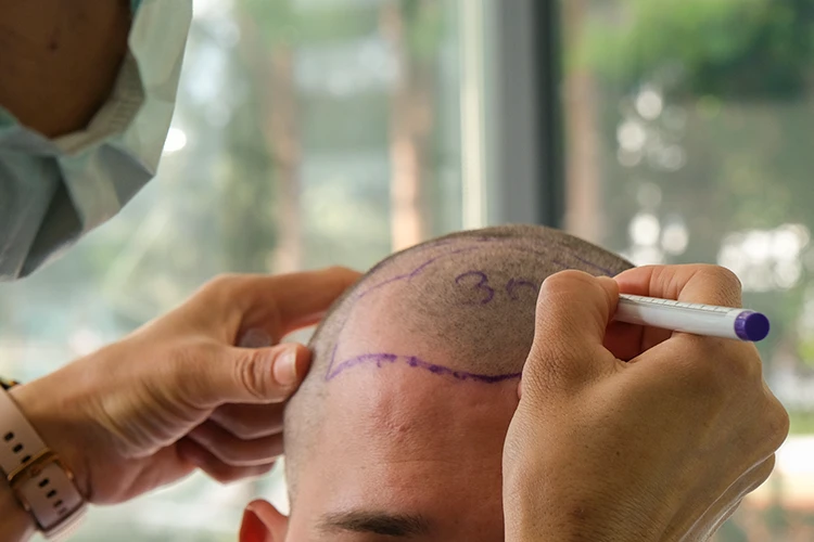 Vorbereitung einer Haartransplantation: Arzt zeichnet die Haarlinie auf die Kopfhaut eines Patienten.