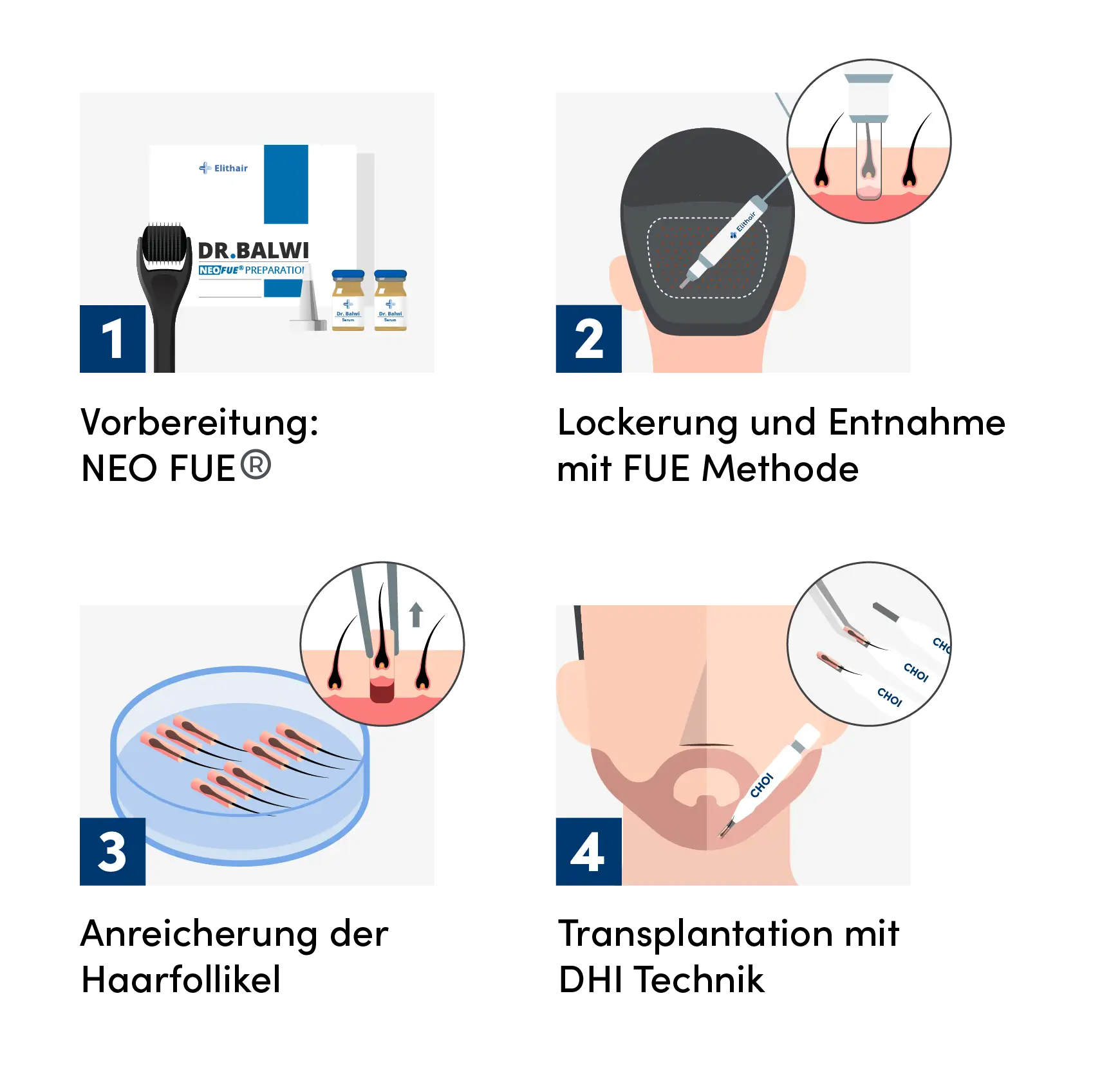 Infografik zeigt die 4 Schritte für die Barttransplantation bei Elithair