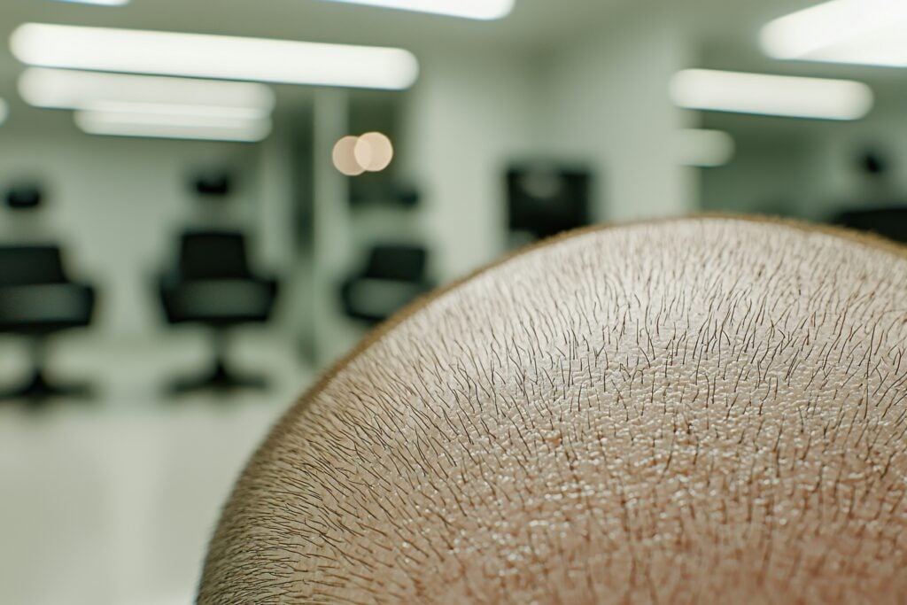 Nahaufnahme einer kahlen Kopfhaut mit dünnen Haarstoppeln