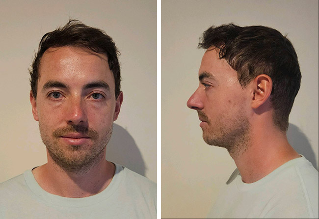 Endergebnis der Haartransplantation bei Marcel Z