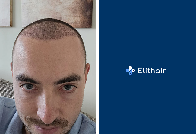 Aufnahme von Marcel Z. kurz nach der Haartransplantation bei Elithair – frisch implantierte Grafts im Bereich der Geheimratsecken