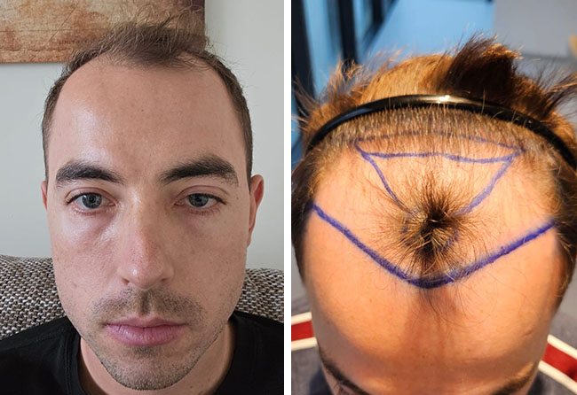 Vorheraufnahme von Marcel Z. vor der Haartransplantation bei Elithair