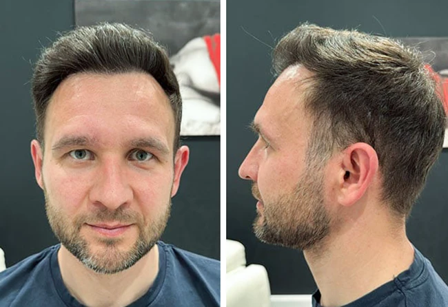 Patient Alexander B. nach seiner Haartransplantation bei Elithair – deutlich voller und dichteres Haar