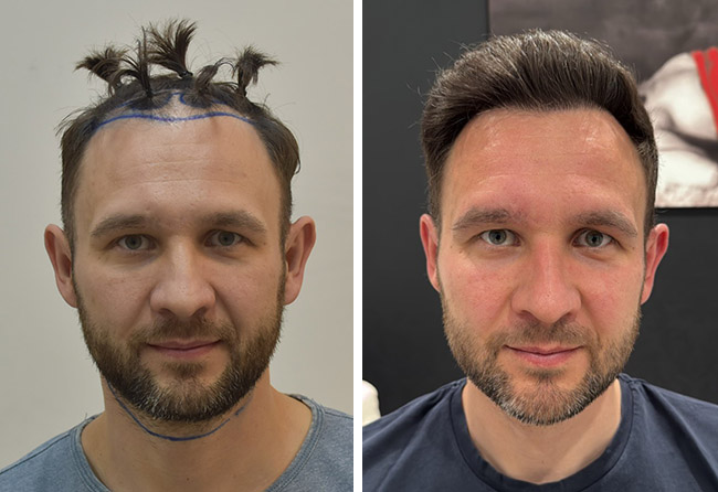 Vorher-Nachher-Vergleich von Alexander B. nach seiner Haartransplantation bei Elithair