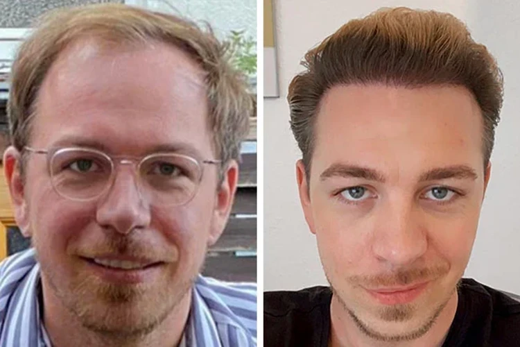 Vorher-Nachher-Ergebnis von Elithair-Patient Tobias P. nach einer Haartransplantation.