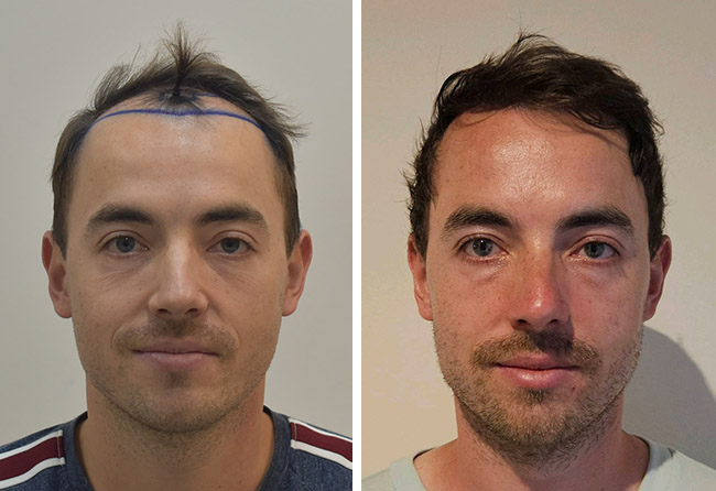 Vorher-Nachher-Vergleich von Marcel Z. nach seiner Haartransplantation bei Elithair