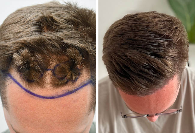 Vorher-Nachher-Vergleich der Tonsur bei Christopher L. nach der Haartransplantation mit Elithair