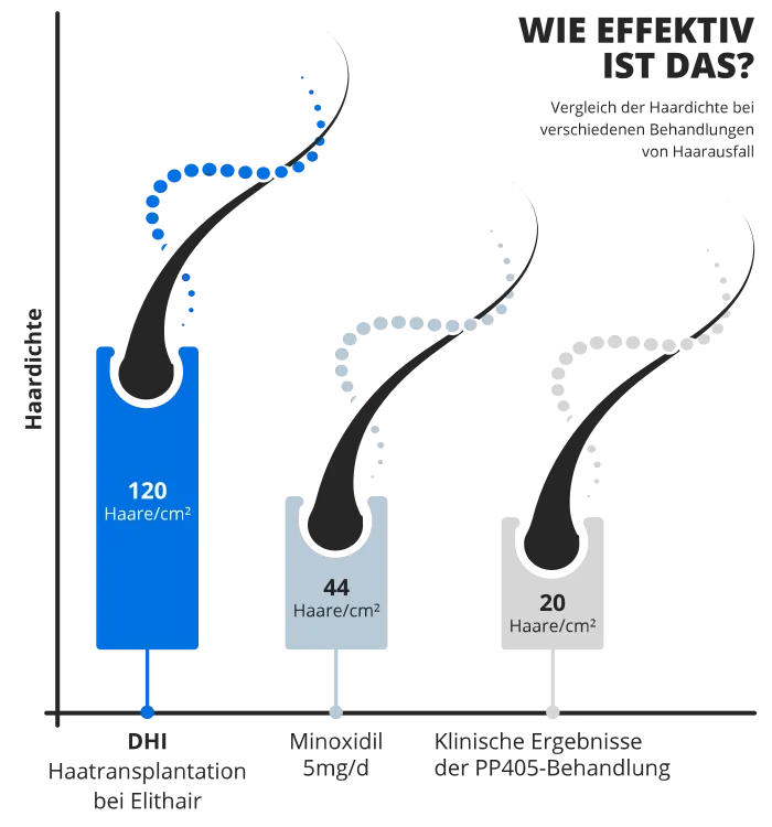 Bild zeigt den Vergleich der Haardichte zwischen der DHI Haartransplantation, Minoxidil und PP450