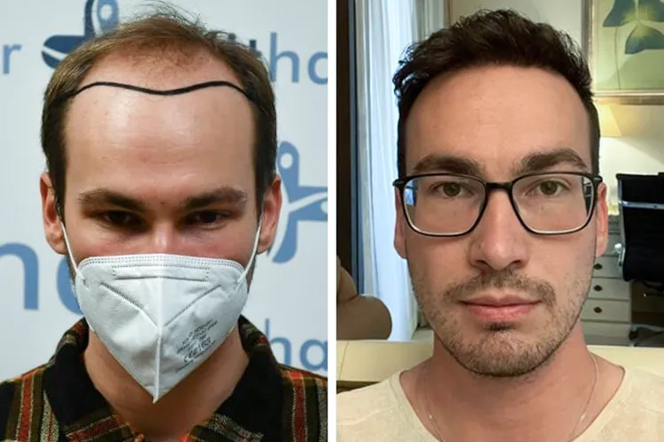 Vorher-Nachher-Bild nach einer Haartransplantation bei Elithair