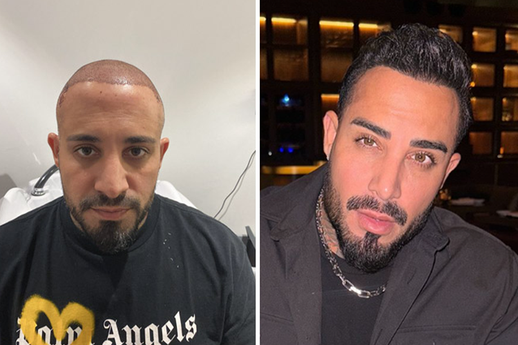 Elithair-Patient Bartmann vor und nach seiner zweiten Haartransplantation – sichtbare Verdichtung des Haaransatzes.
