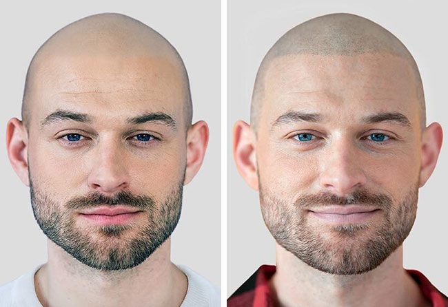 Vorher-Nachher-Ergebnis einer Haarpigmentierung