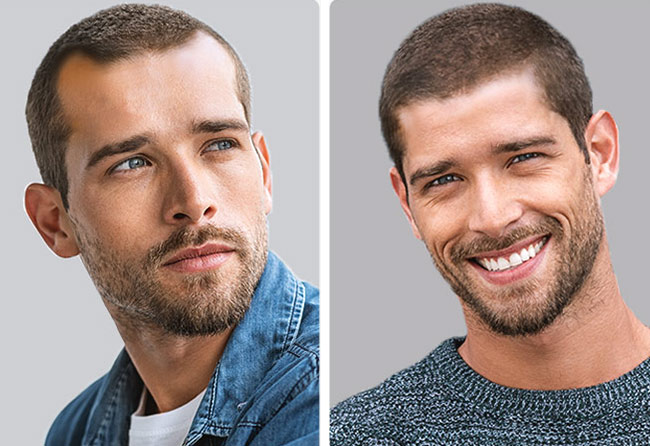 Patient vor und nach der PRP-Behandlung bei Elithair