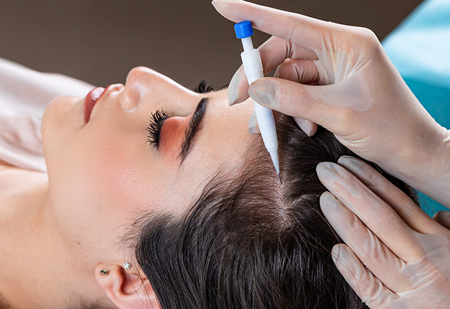 Patientin während einer Haartransplantation mit der DHI-Technik, Haarfollikelentnahme mithilfe eines Choi-Implantationsstifts.