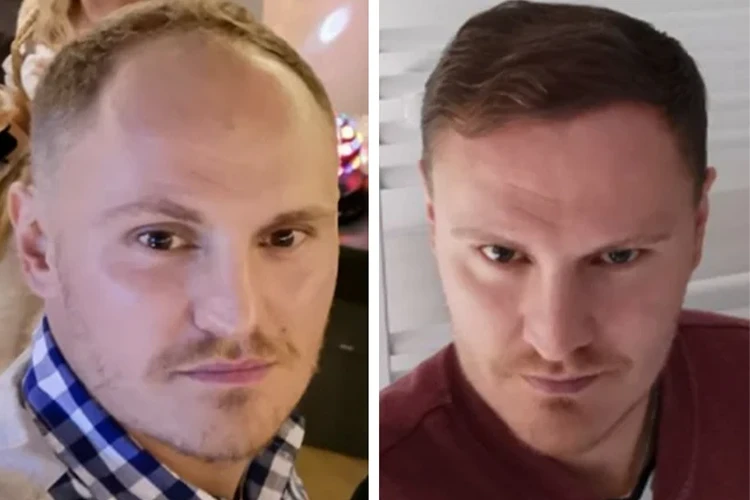 Vorher-Nachher-Ergebnis von Elithair-Patient Tim H. nach einer Haartransplantation – sichtbar verbesserter Haaransatz und ein insgesamt dichteres Haarbild.