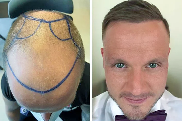 Vorher-Nachher-Bild eines Mannes nach einer Haartransplantation bei Elithair