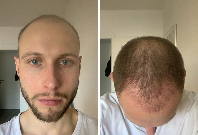 Vorher nachher DHI Haartransplantation mit 4000 Grafts bei Patient Niklas N. nach 2 Monaten