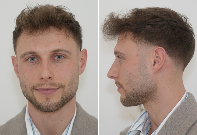 Nachher DHI Haartransplantation mit 4000 Grafts bei Patient Niklas N.