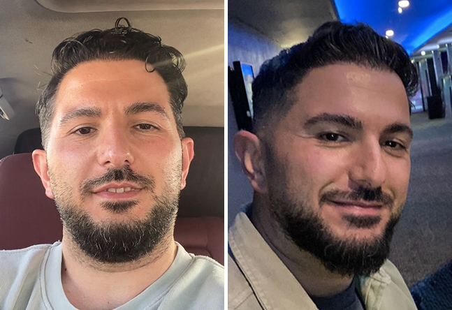 Nachher DHI Haartransplantation mit 4200 Grafts bei Patient Onur Y.