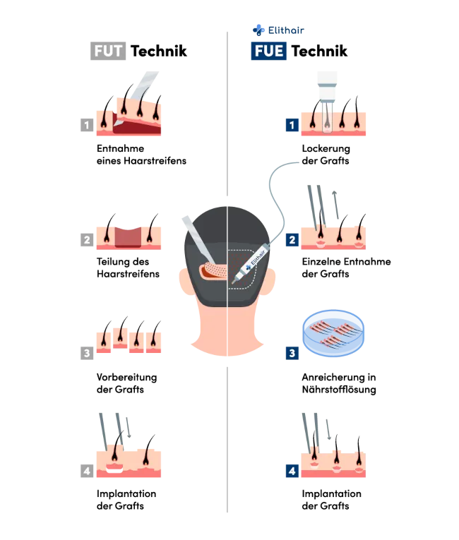Infografik vergleicht FUT- und FUE-Haartransplantation