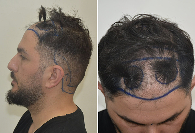 Vorher DHI Haartransplantation mit 4200 Grafts bei Patient Onur Y.