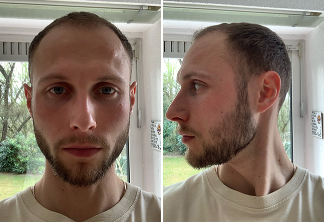 Vorher nachher DHI Haartransplantation mit 4000 Grafts bei Patient Niklas N. nach 4 Monaten