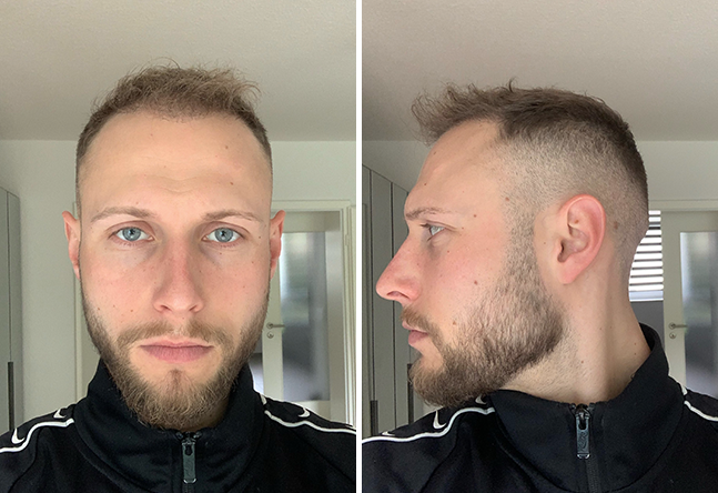 Vorher nachher DHI Haartransplantation mit 4000 Grafts bei Patient Niklas N. nach 6 Monaten