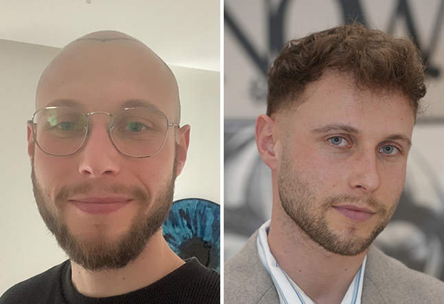 Vorher nachher DHI Haartransplantation mit 4000 Grafts bei Patient Niklas N.