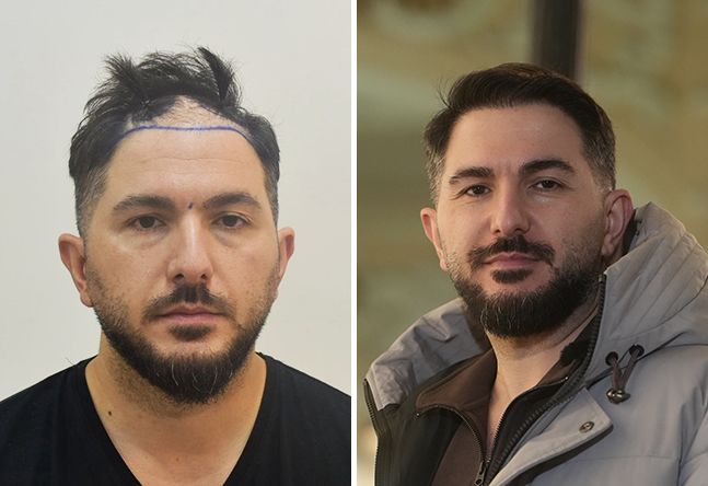 Vorher nachher DHI Haartransplantation mit 4200 Grafts bei Patient Onur Y.