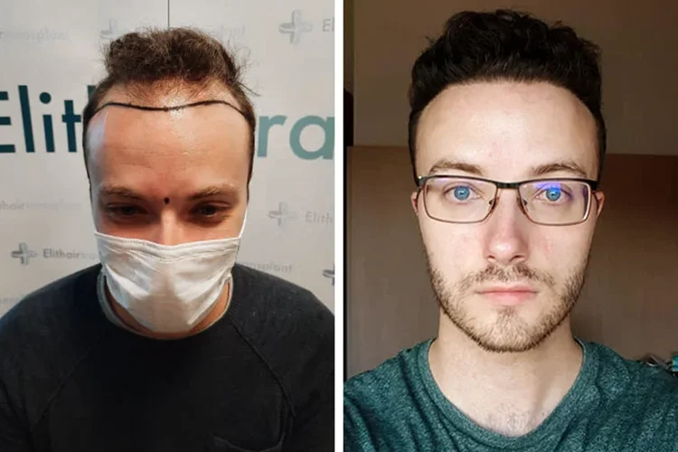 Vorher-nachher-Bild von Elithair-Patient Didac S. nach Haartransplantation