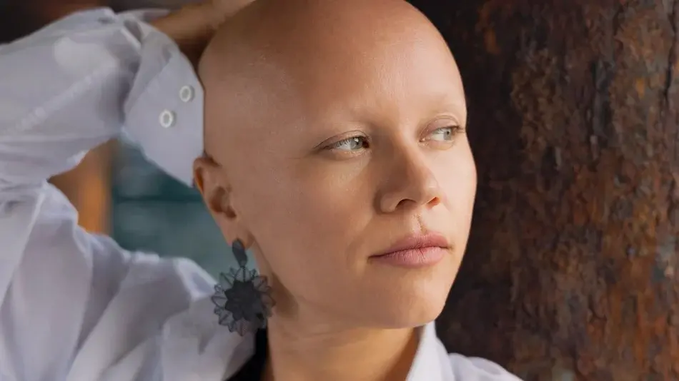 Bild zeigt eine Fraue mit Glatze und ohne Augenbrauen, die an Alopecia Areata leidet