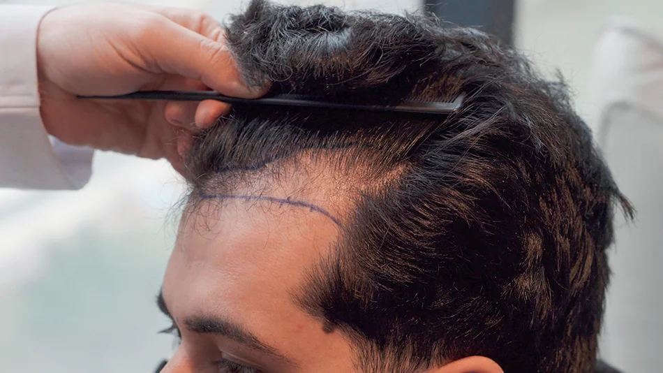 Nahaufnahme einer markierten Haarlinie auf der Stirn eines Mannes während der Vorbereitung auf eine Haartransplantation.
