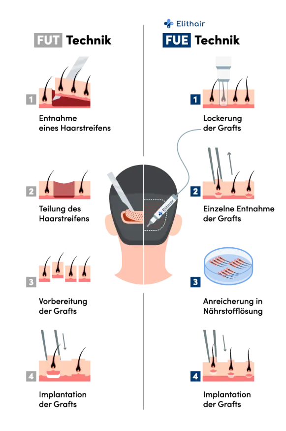Infografik zum Vergleich der FUT und FUE Technik zwecks Entnahme der Haarfollikel aus dem Spenderbereich bei der Haartransplantation